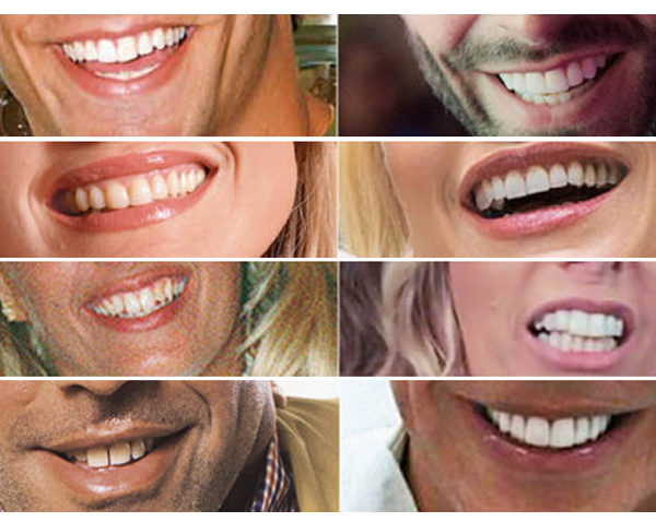 Lentes de contato dental ou Ortodontia e clareamento em dentes saudáveis?
