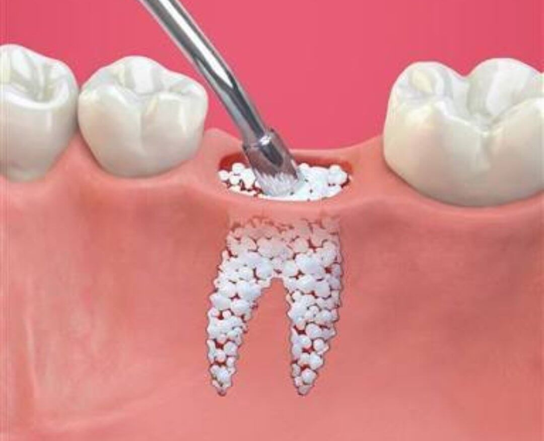Зуб без кости. Костная пластика (остеопластика). Костный материал в стоматологии. Костная пластика в стоматологии.